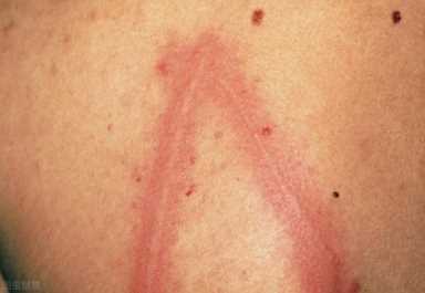 皮肤划痕症怎么治疗，皮肤划痕症的有效治疗方法