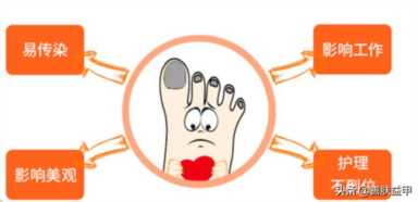 治疗灰指甲的小窍门，灰指甲的家庭护理与预防妙招