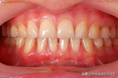 为什么会发生牙龈炎，牙龈肿痛十大消炎药