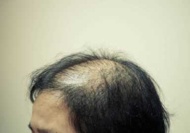 脂溢性脱发怎么治疗--头发能长出来吗？