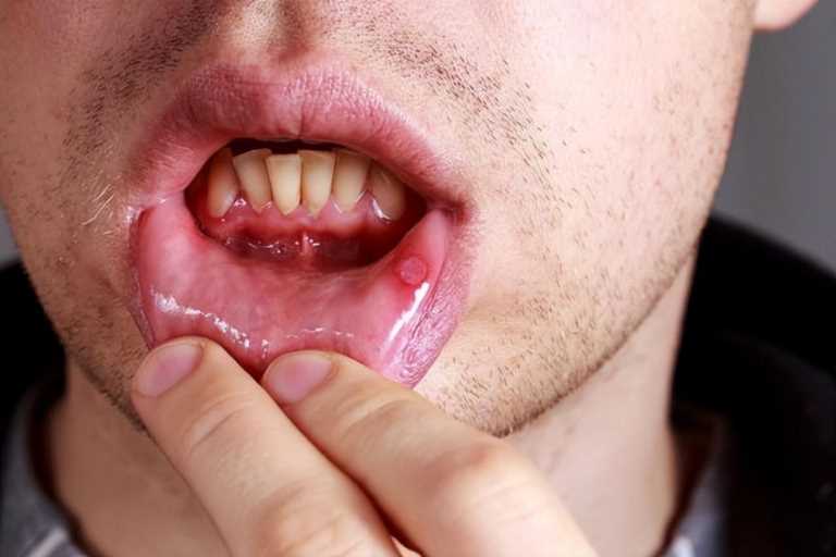 艾滋的早期症状舌头图片（艾滋病的口腔症状是什么）