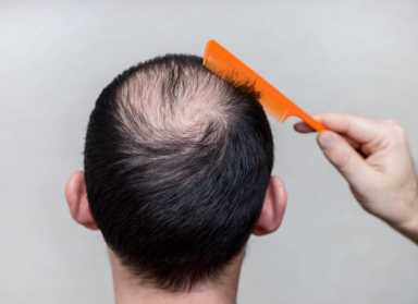 脂溢性脱发怎么治疗--头发能长出来吗？