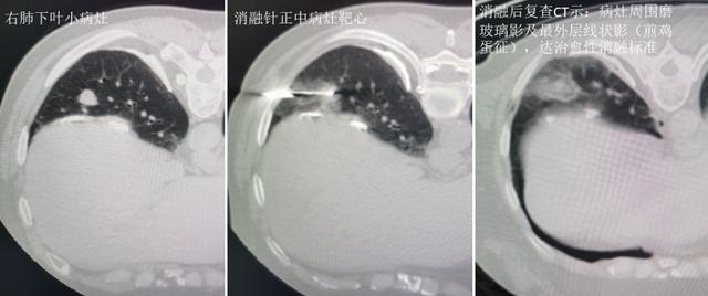 早期肺癌介入治疗方法，北京治疗肺的医院哪个好